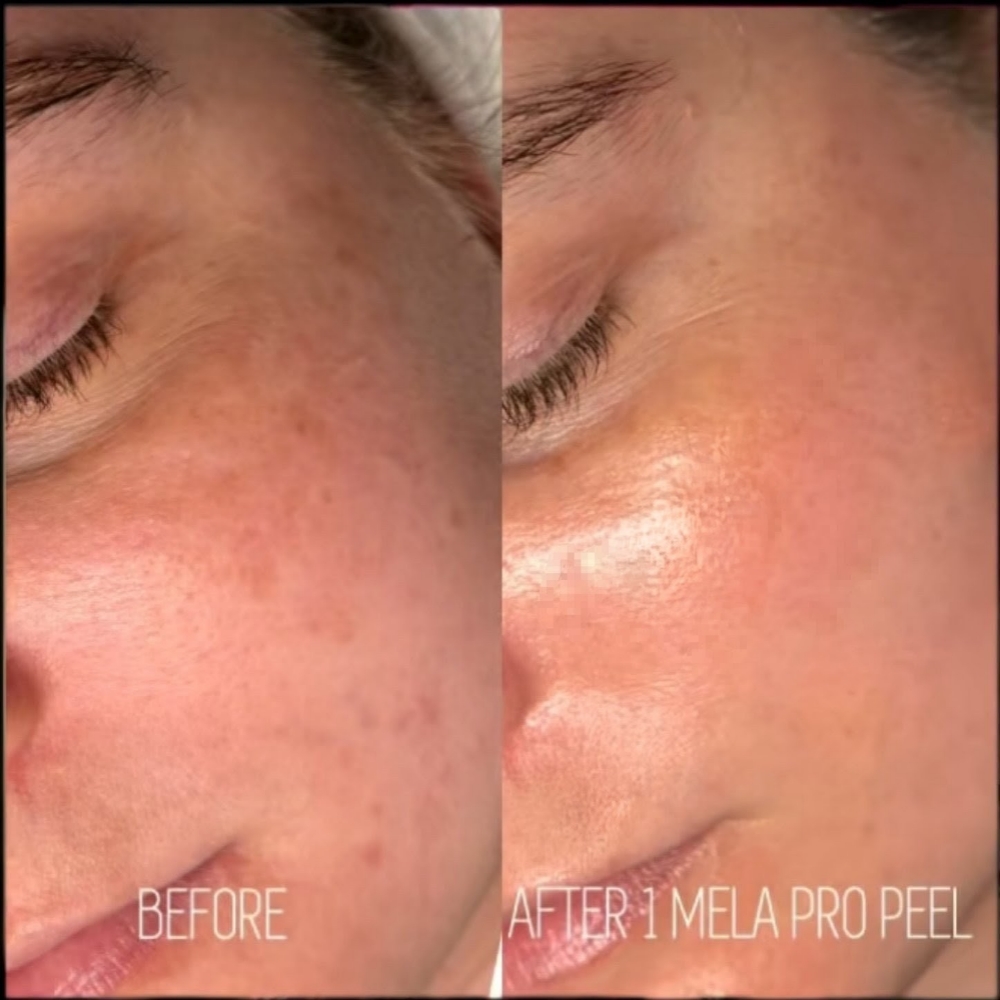 Melasma Korean Cold Peel at LexGlo Esthetics in Idaho Falls, ID