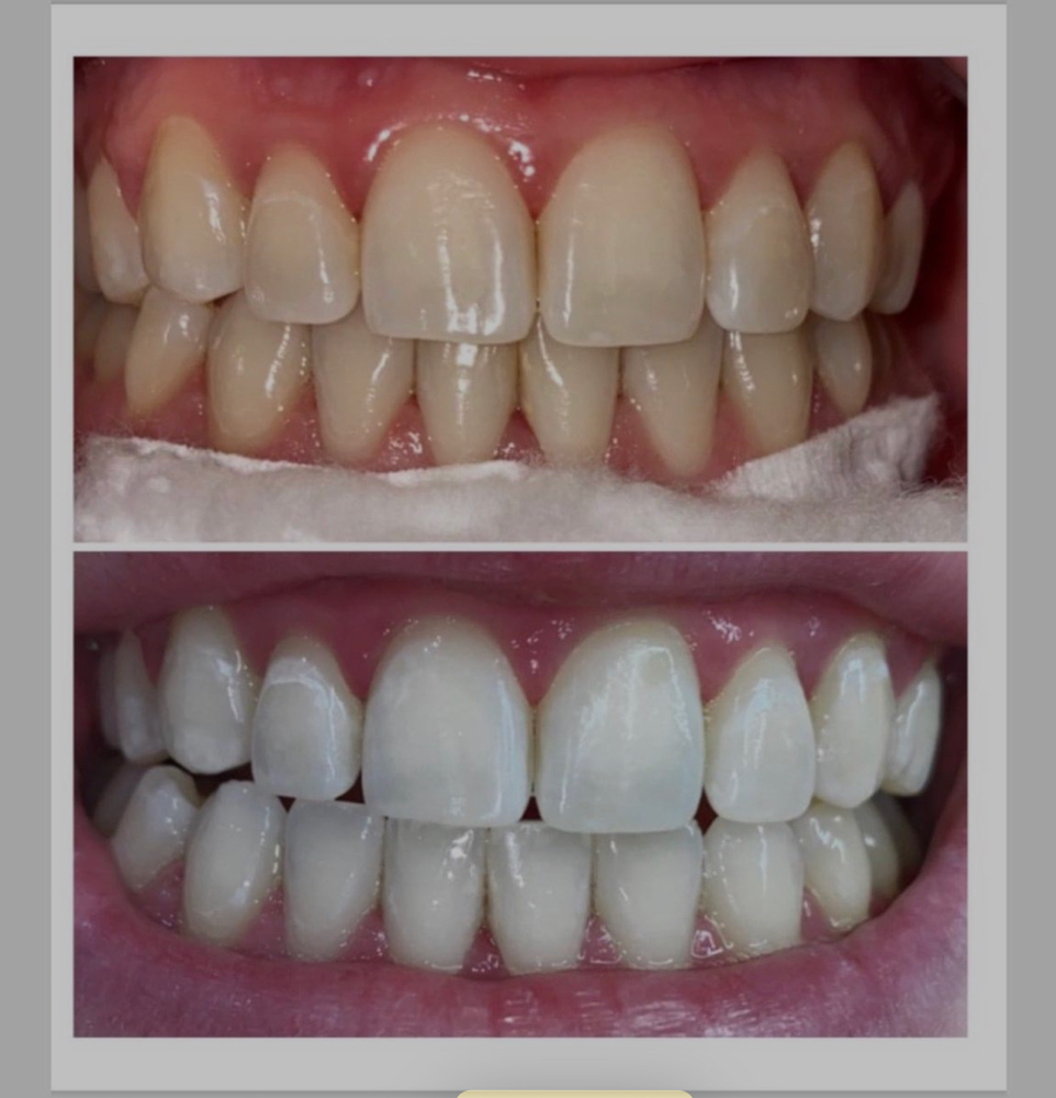Teeth Whitening