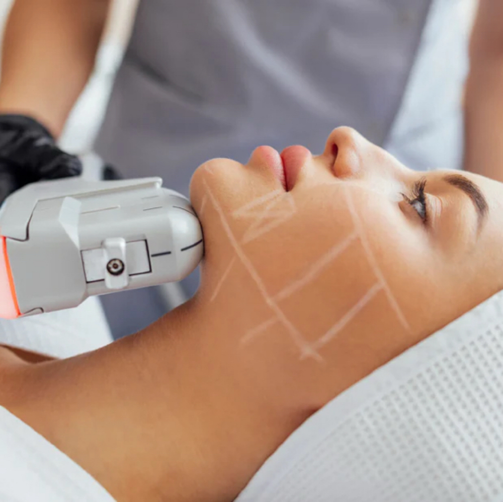 Hifu Facial at SiempreBellasBeautySpa in North Miami, FL