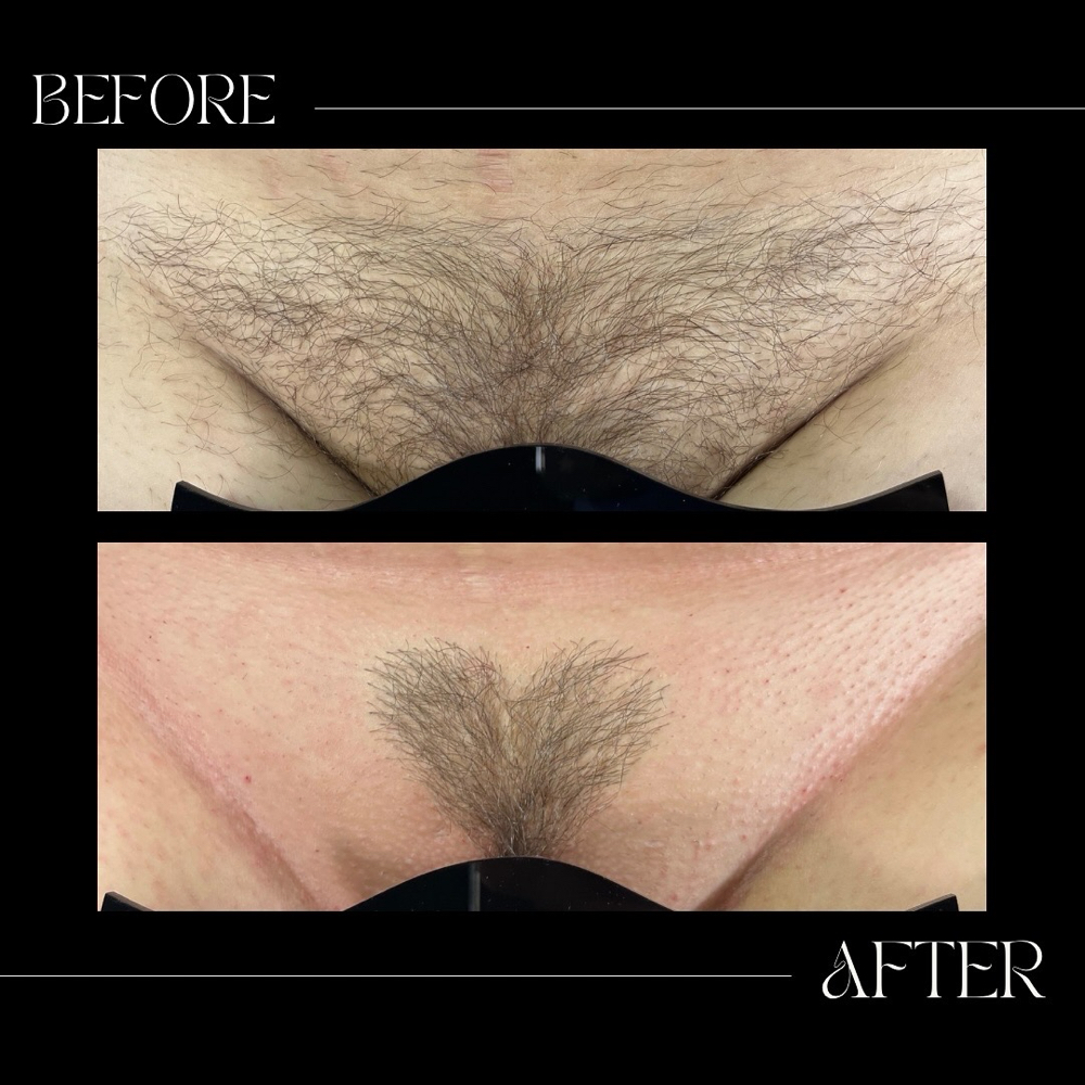 Brazilian Shape Add-on at Star Esthetics in Columbus, OH