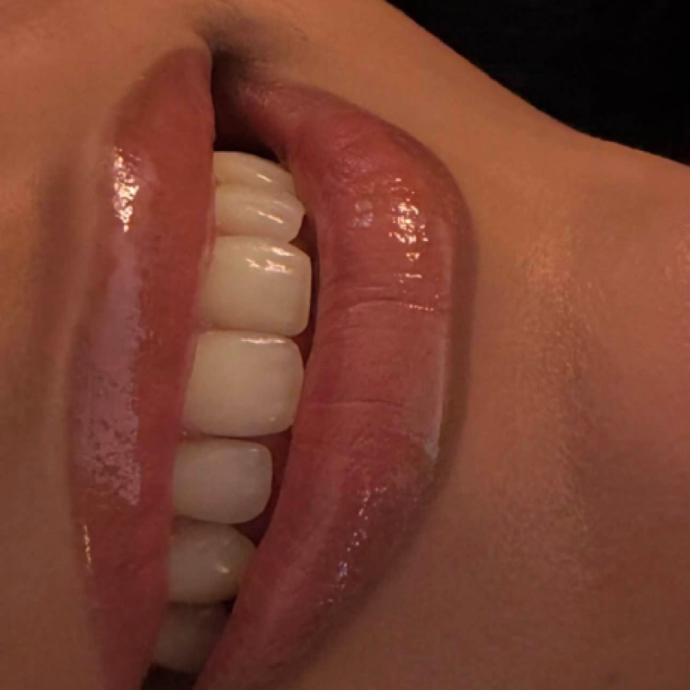 Teeth Whitening at Get AT me Beauty in Chula Vista, CA