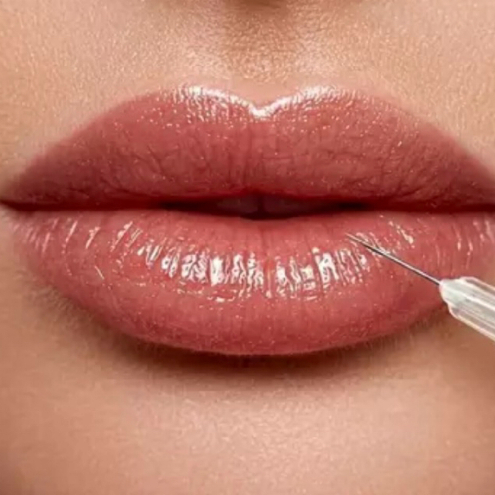Revanesse Lips With Lidocaine-Half at Hypnotic Aesthetic in Lavon, TX
