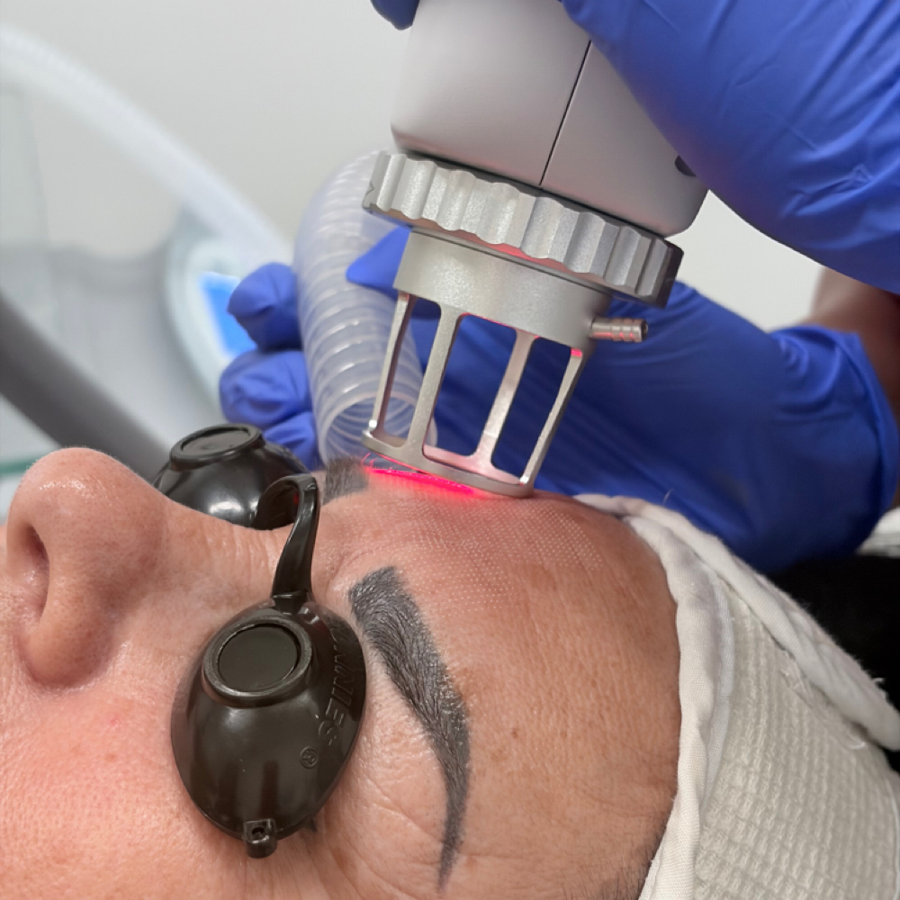 Co2 Full Face Skin Resurfacing at Skin Commitment LLC in Brownsville Tx, TX