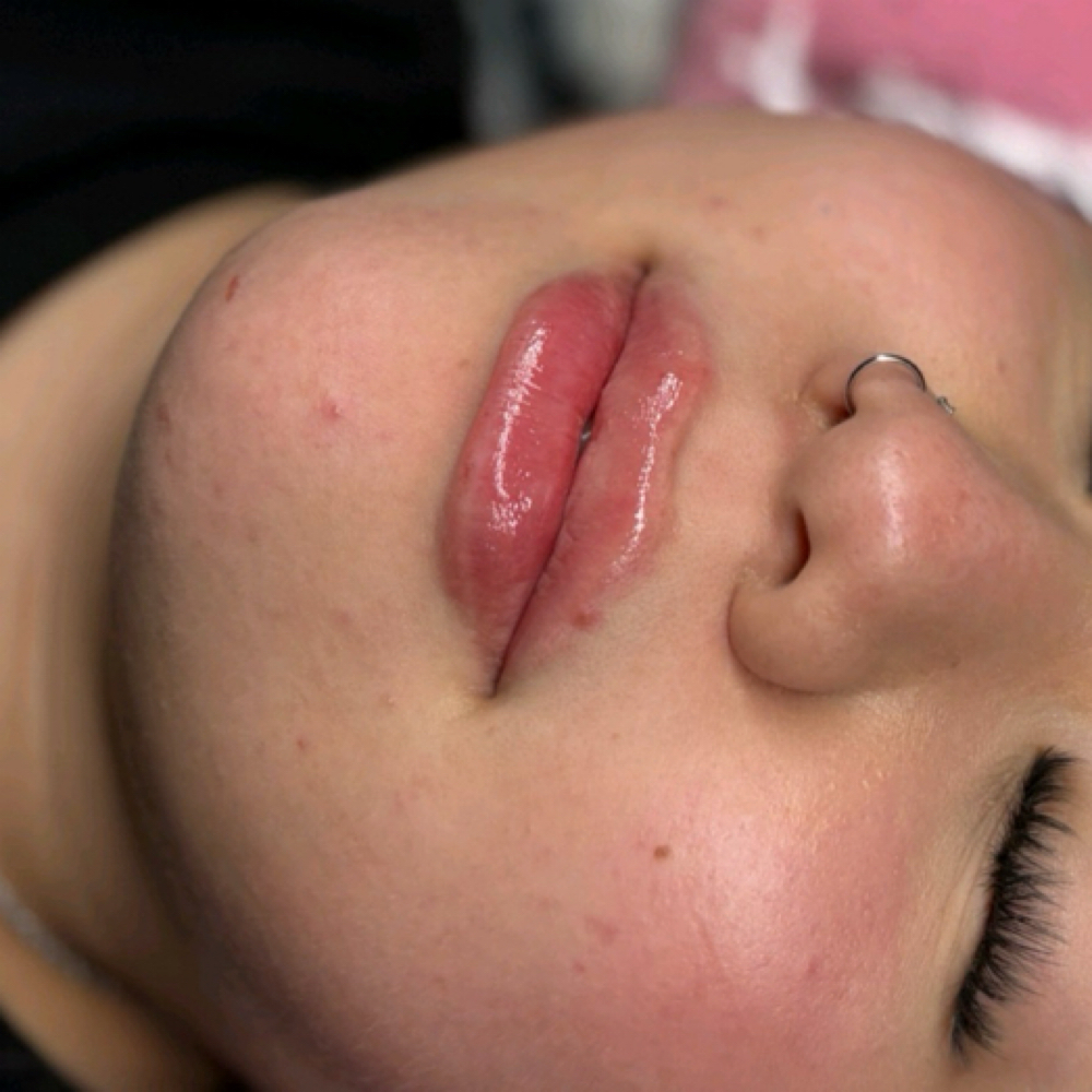 Micro Needle at Gloo Beauty in Port Neches, TX