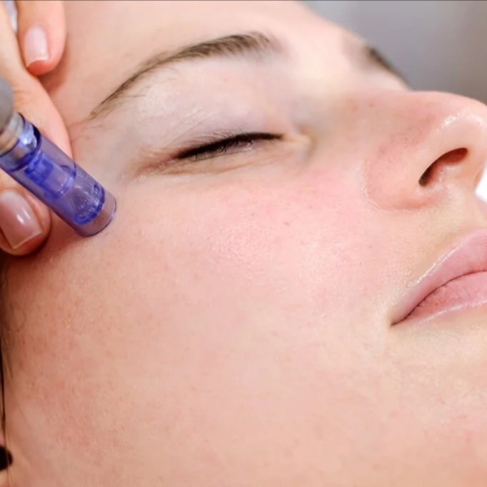 Micro needling at Rejuven Esthetic in vienna, VA