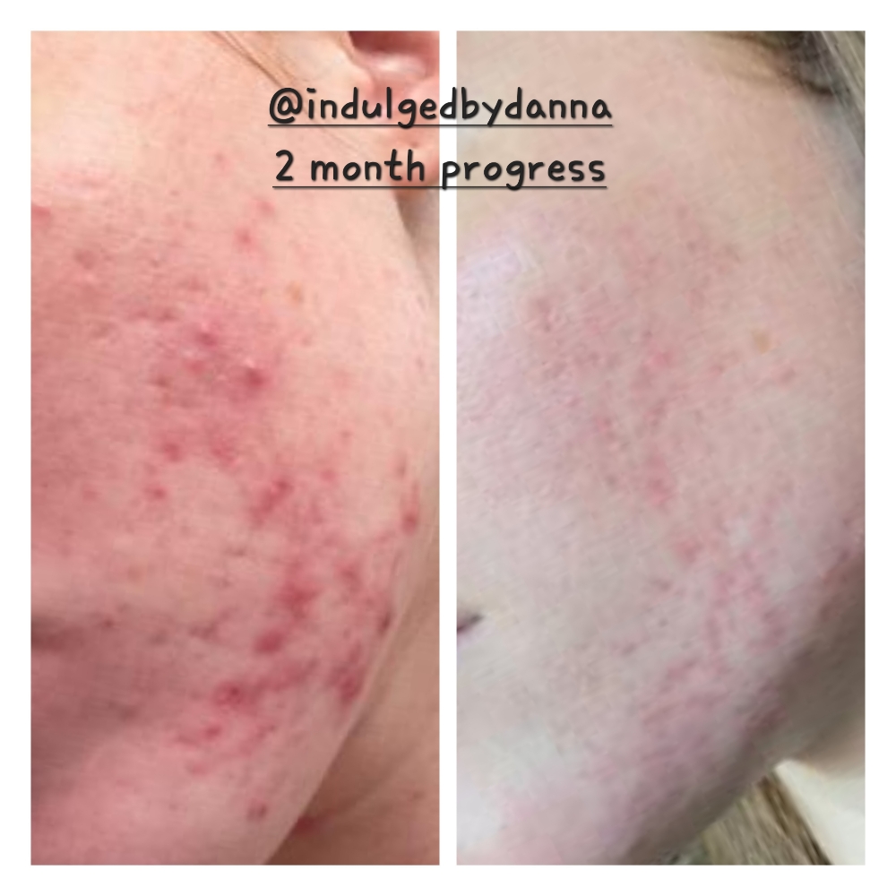 Acne Treatment