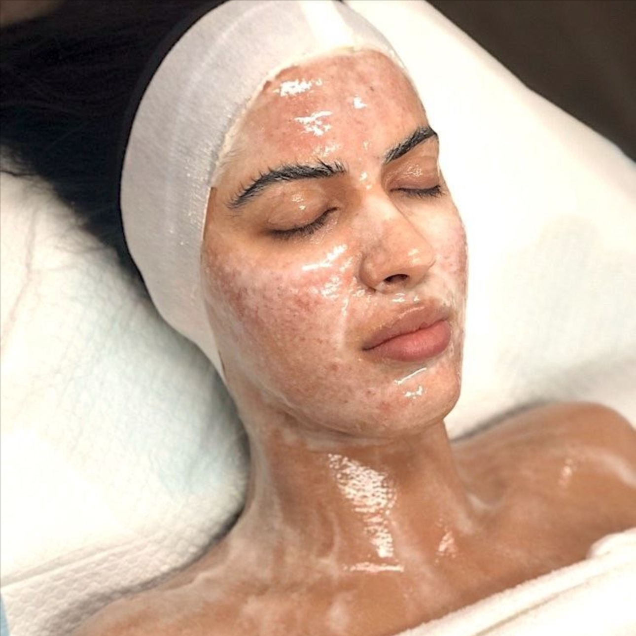 Intensive Acne Treatment at Anastacia Beauty Lounge in Lake Park, FL