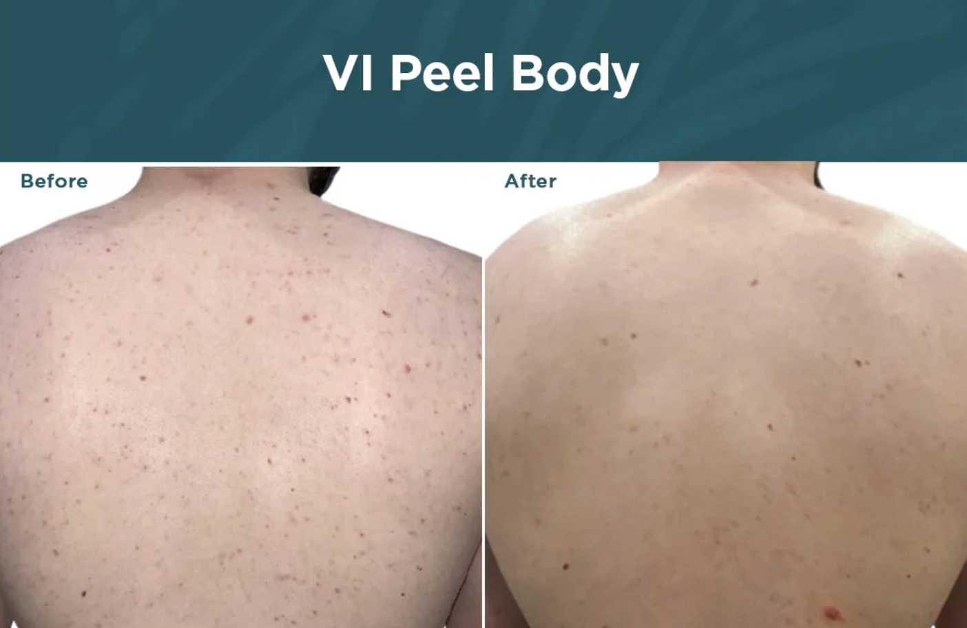 VI Peel Body - Large Area