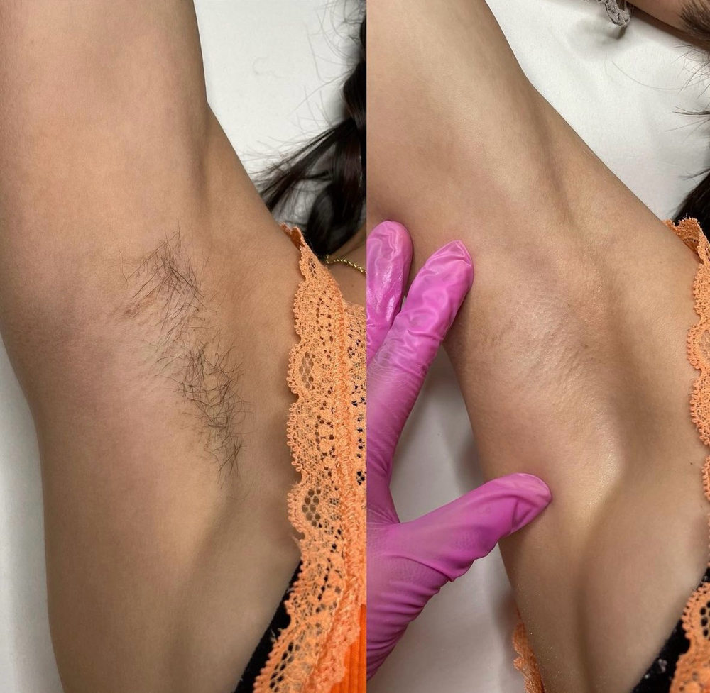 Underarm Wax