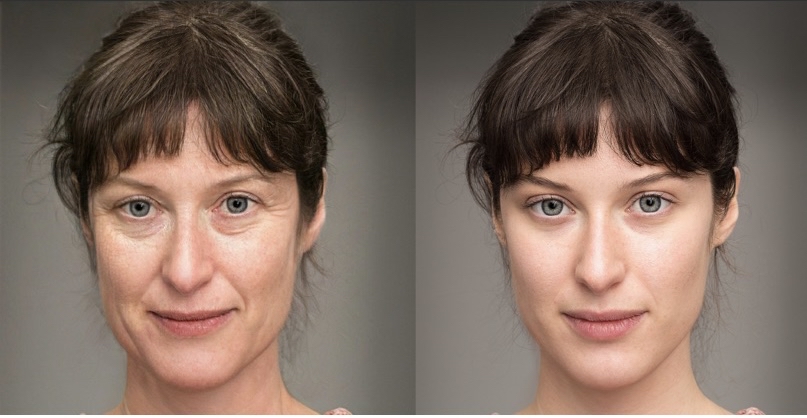 Chemical Peel