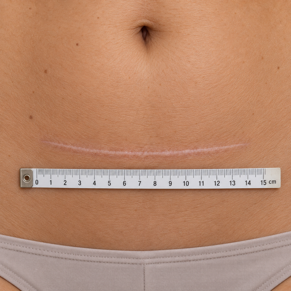 Medium Scars ( Upto 5 Inches) at Fine Arches in Woodside, NY
