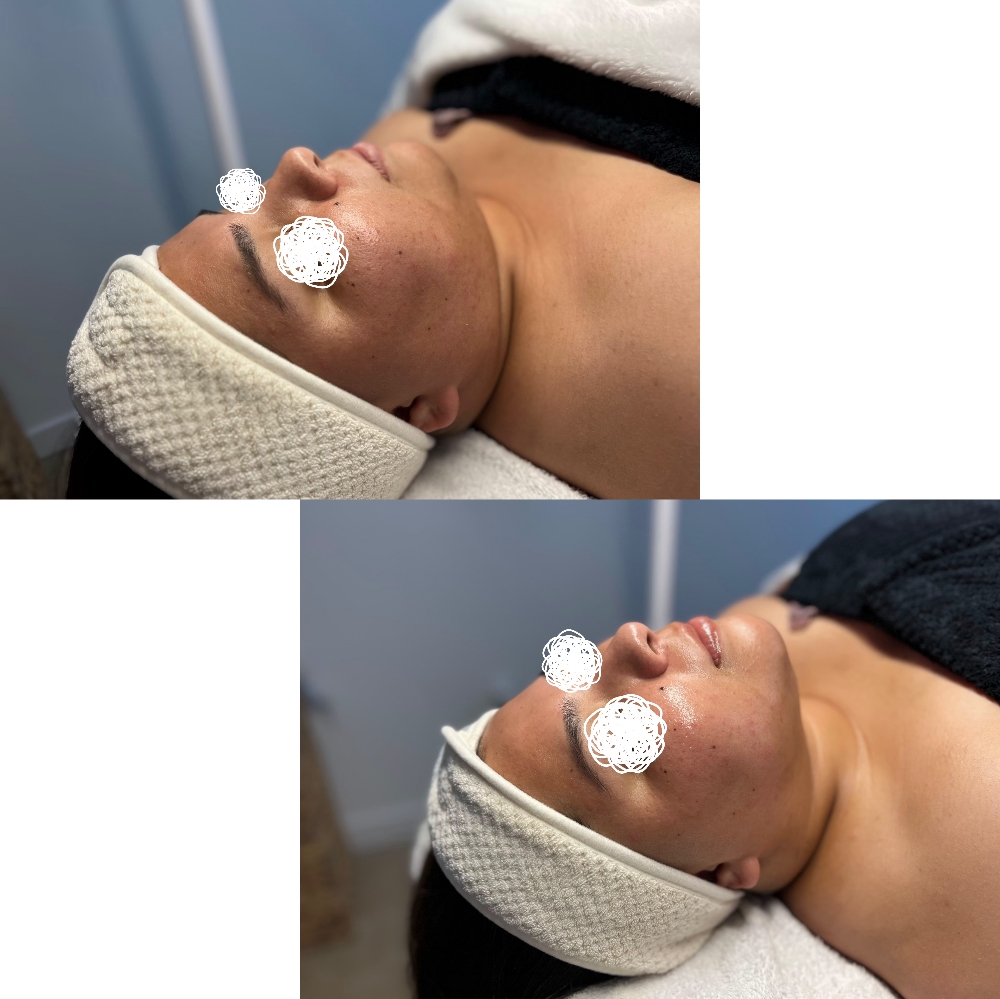 Deluxe Dermaplane Facial at Nora's Pampering Esthetics in Escondido, CA