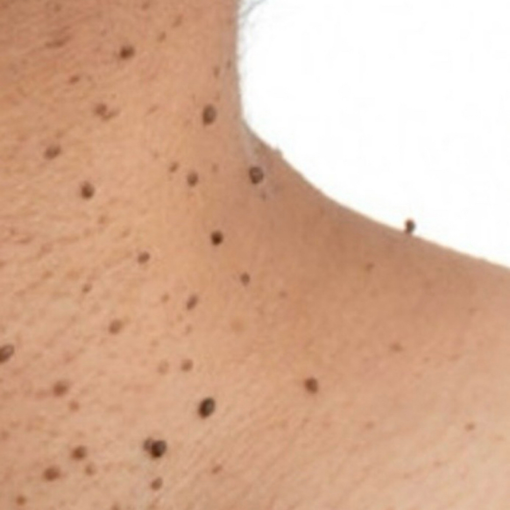 Wart removal / Berrugas at Yeni L Skin Care in Brooklyn, NY