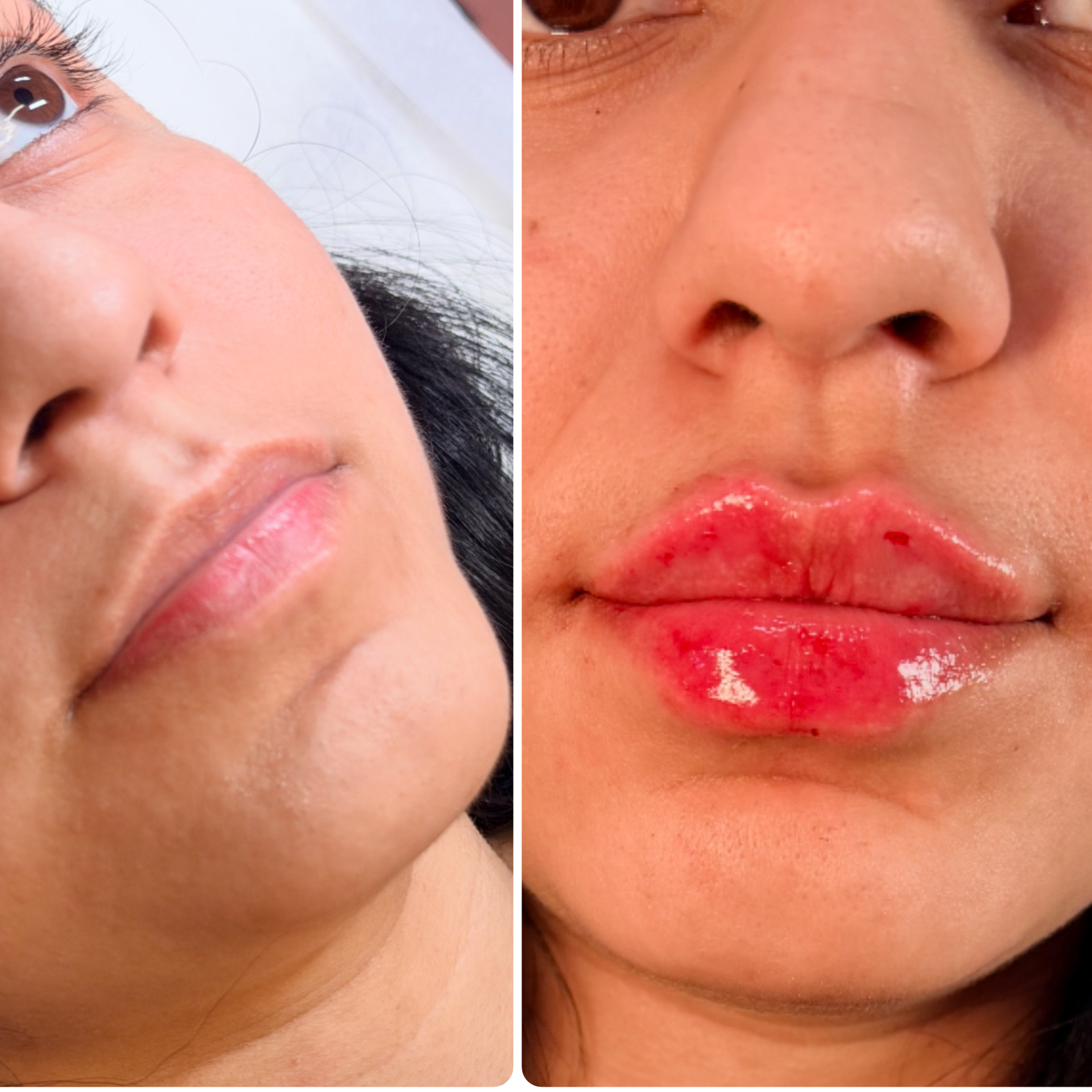 The Full Glam lip (1ml) at TLN AESTHETICS MEDSPA in Lanham, MD
