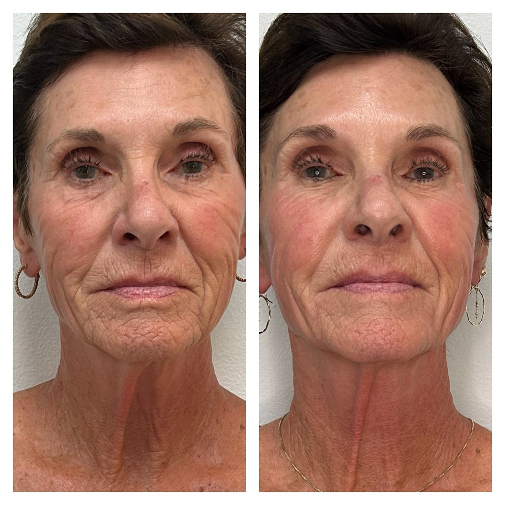 LIFT & SCULPT Fascia/Microcurrent at Modern Esthetics in Katy, TX
