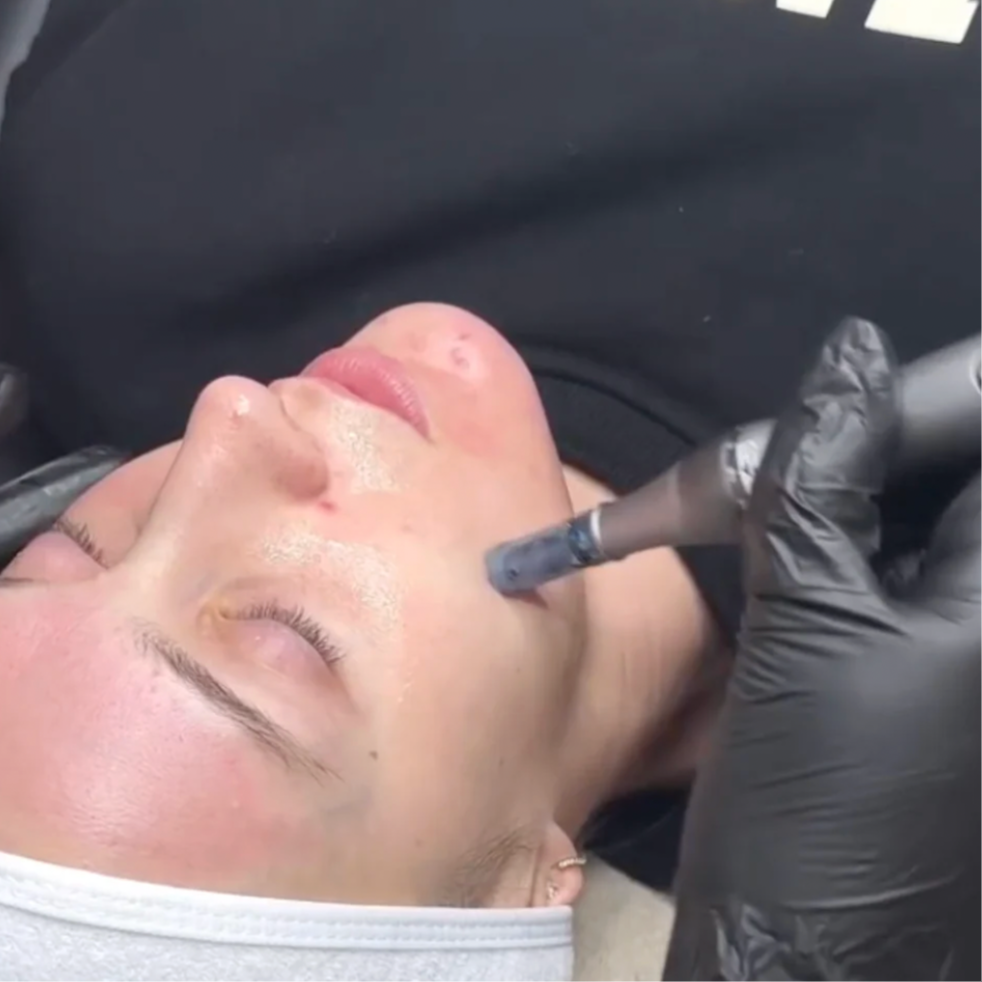 Microneedling at Monarch Beauty Collective in Brentwood, MO