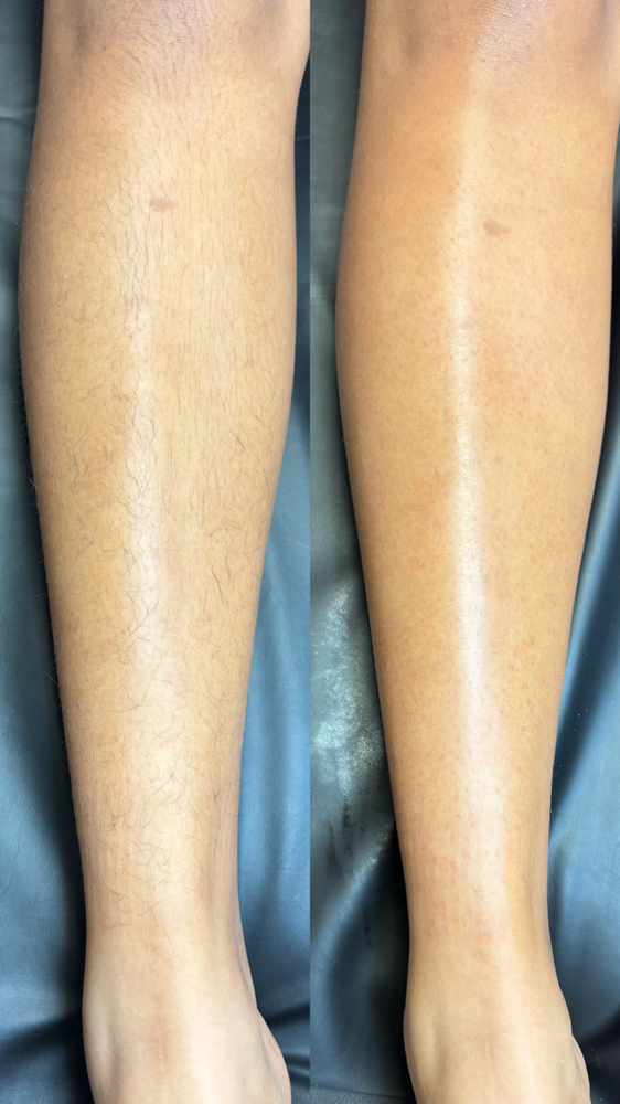 Full Legs at Golden Vanity Aesthetics in Riverside, CA