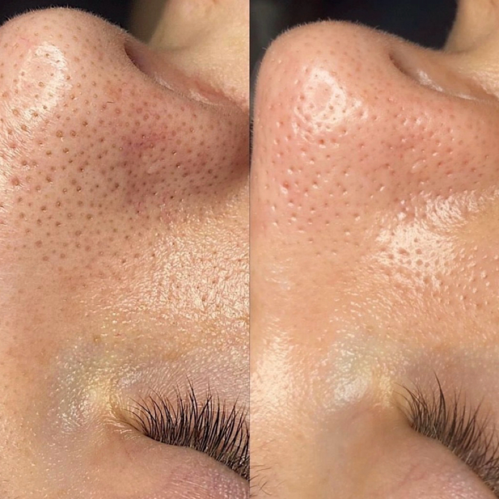 PLATINUM HYDRAFACAIL at OH  BEAUTY  BAR in Bellingham, WA