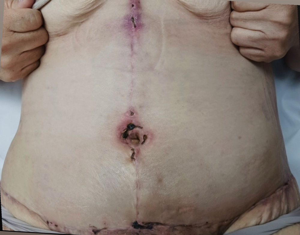 Penniculectomy Lymph Drainage