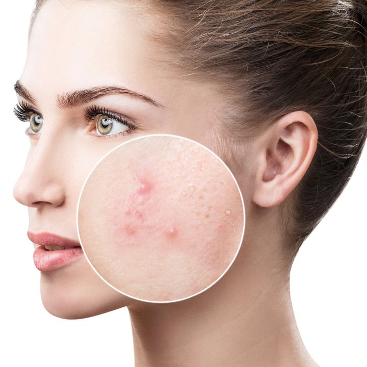 Acne Fighting Facial