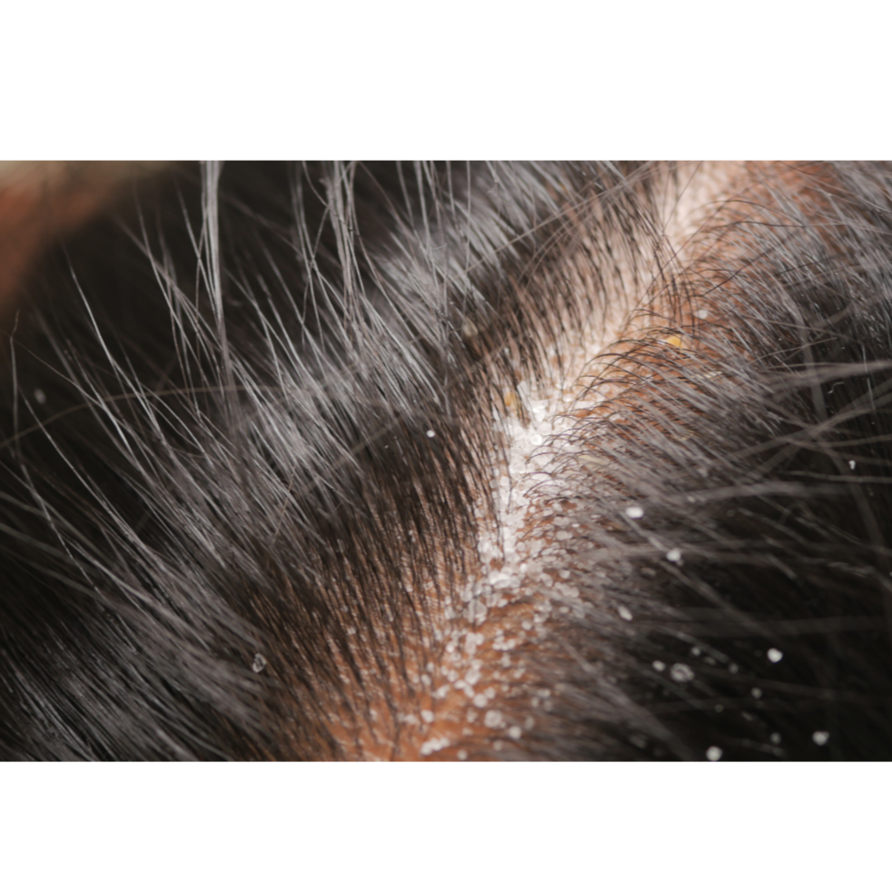 Scalp ultrasonic exfoliation at Body Essentials HSV, Wellness and Beauty LLP in Huntsville, AL