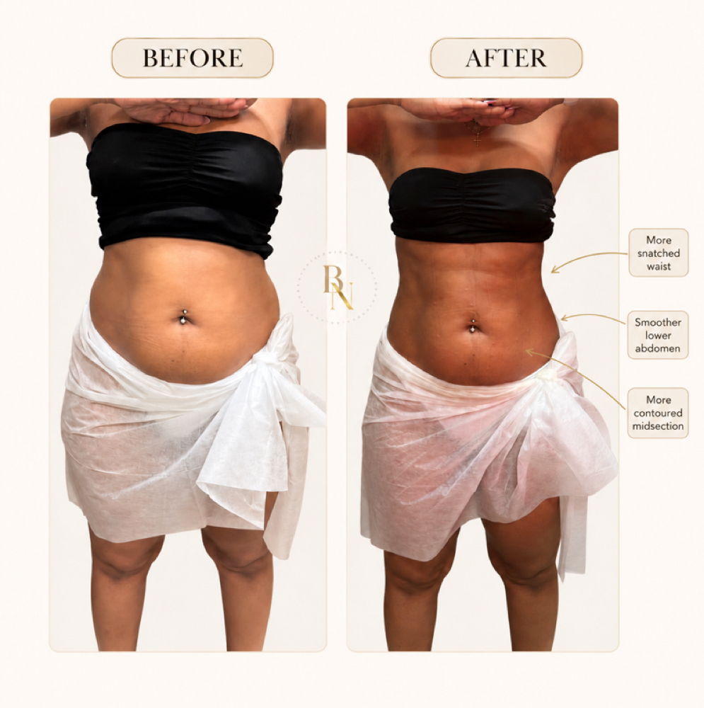 LIPO SHOT + BODY SCULPTING (1) at BODIEDBYNICKEI LLC in The Bronx, NY