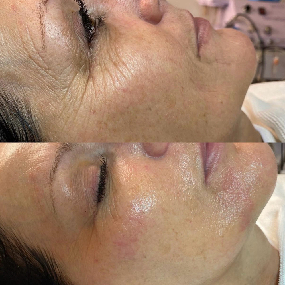 Nano Needling (MicroExfoliation) at SKIN by Christine Russell in Green Bay, WI