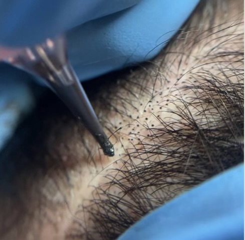 Scalp Micropigmentation at Anew Med Spa in Baker City, OR