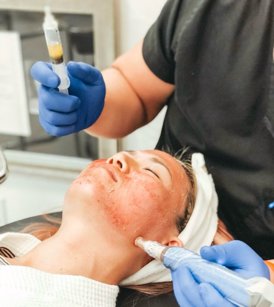 Fibrin Glow at Zoraya Velez AESTHETICIAN in Richmond, VA