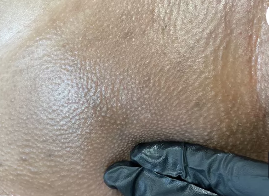 Brazilian wax