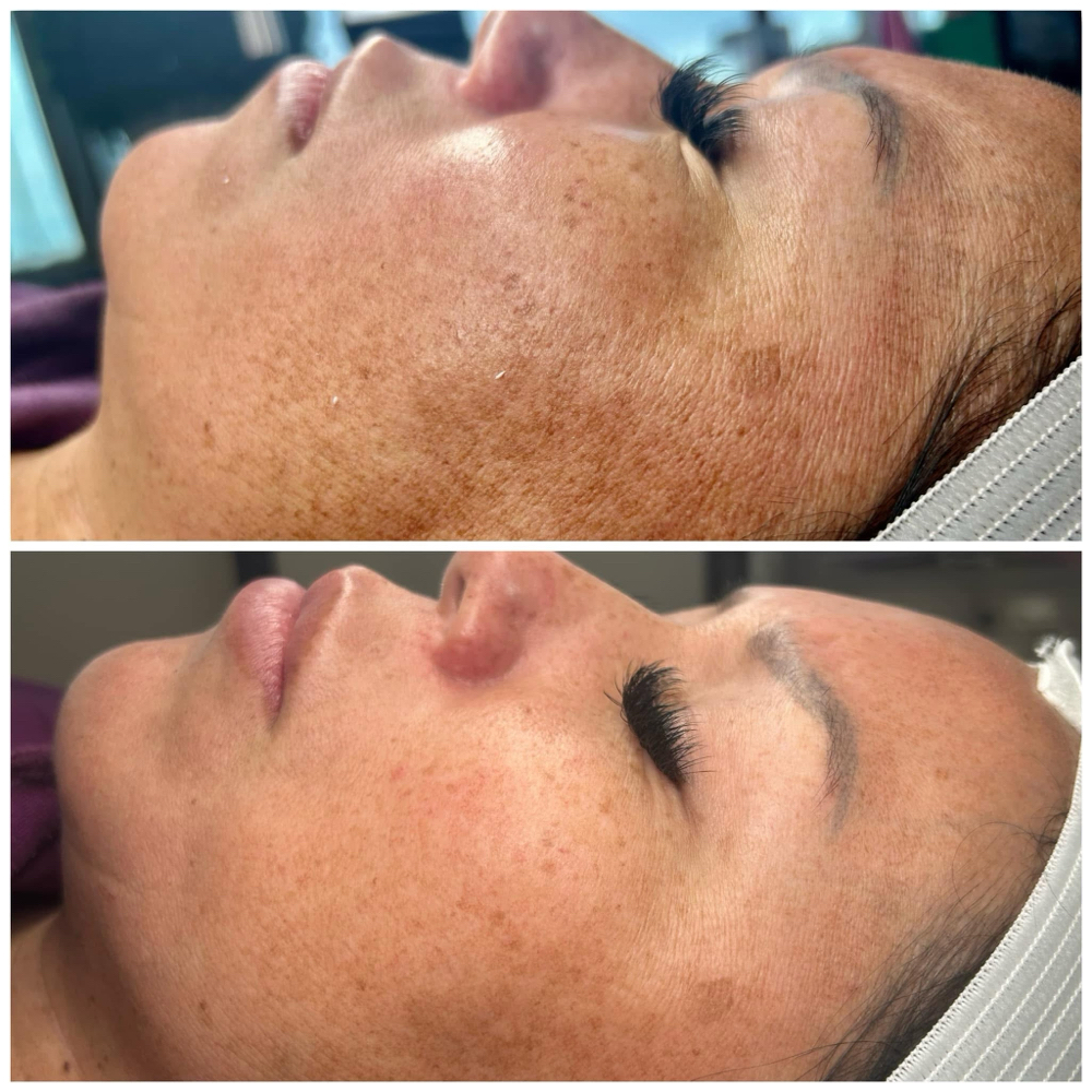 Jessner Peel at ReNew in Fort Lauderdale, FL
