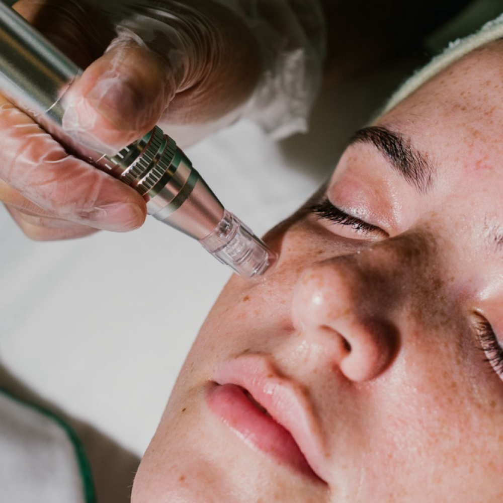 Nano needling (5 sessions) at Esthetics By Bailey in Crossville, TN