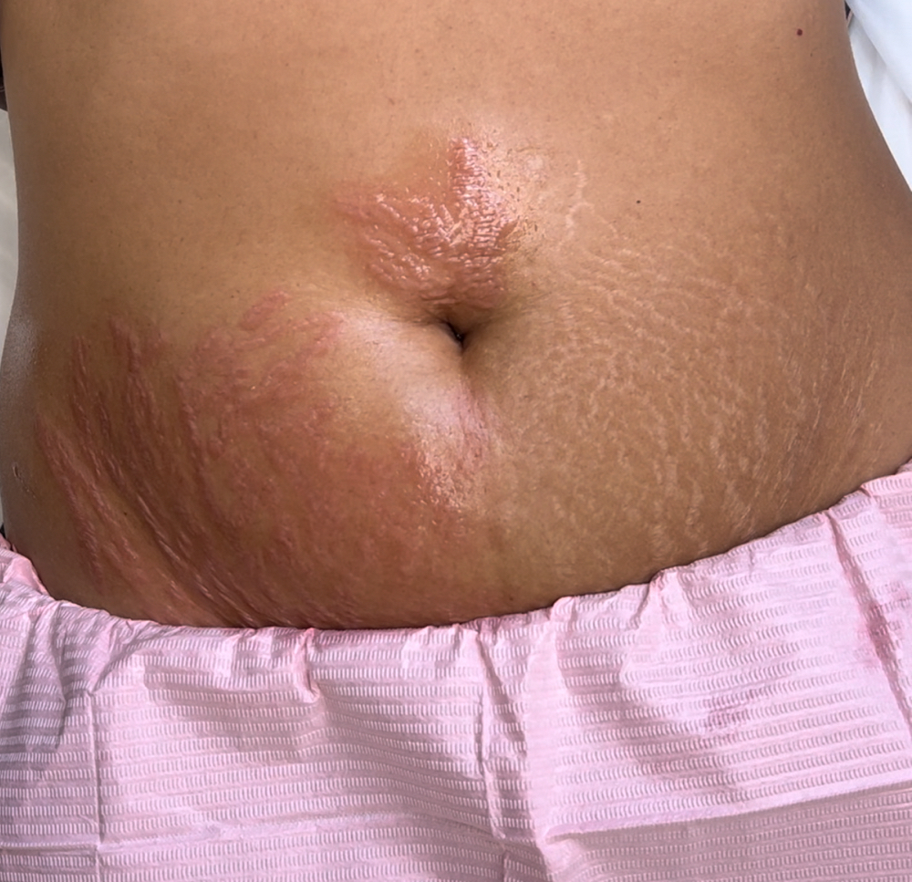 Camouflage Stretch Mark Pick 1 Area at Jane Rozier Permanent Makeup & Esthetics in Bellevue, NE