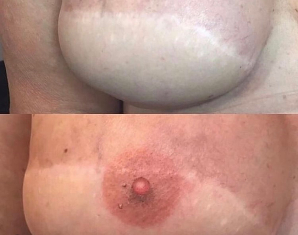 Areola Restoration