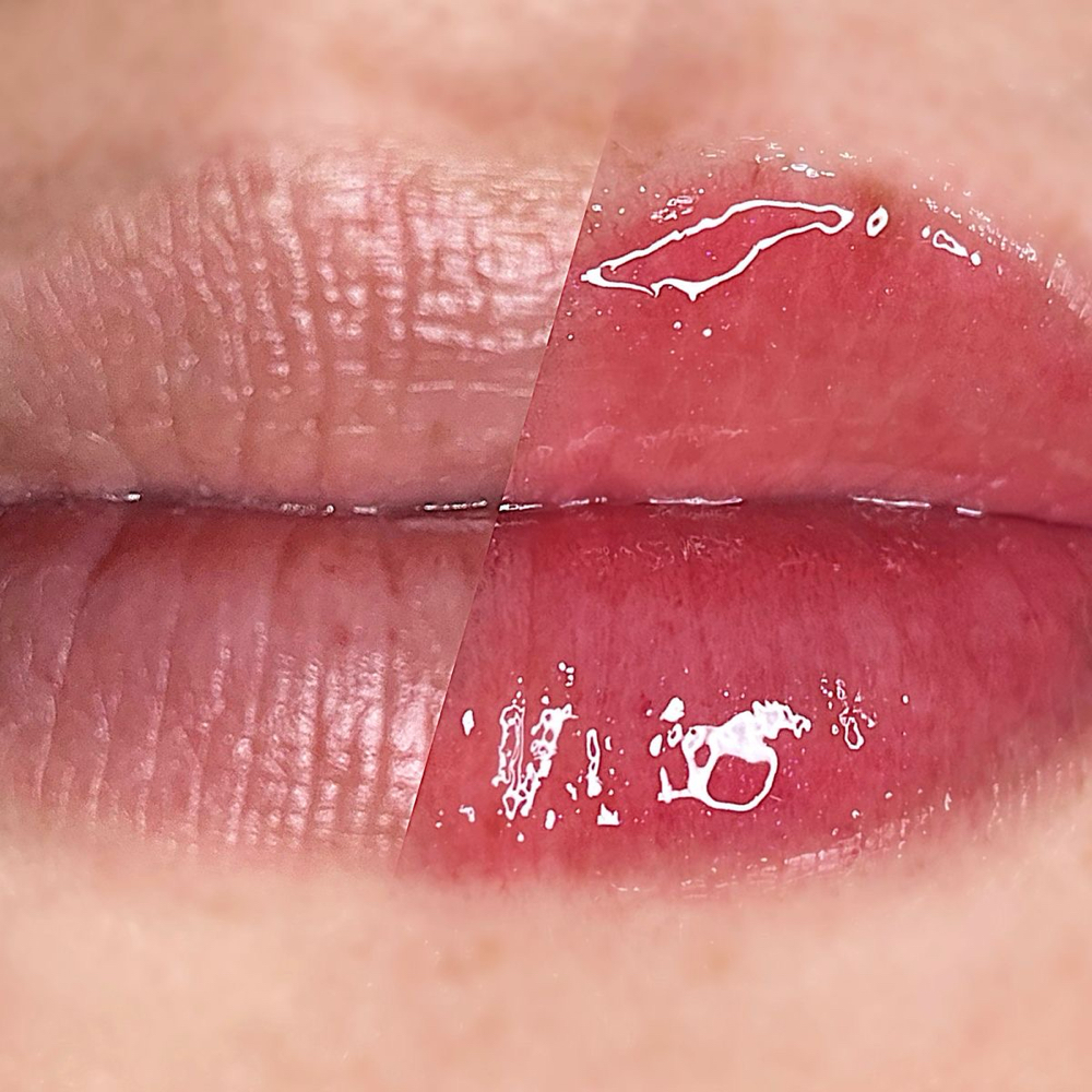 Lip Treatment