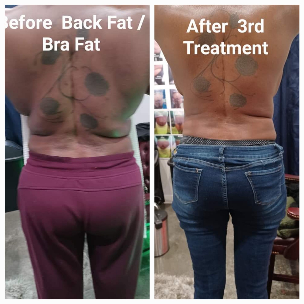 4 TREATMENT   BACK FAT