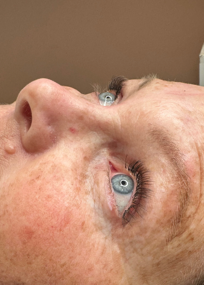 Lash Removal