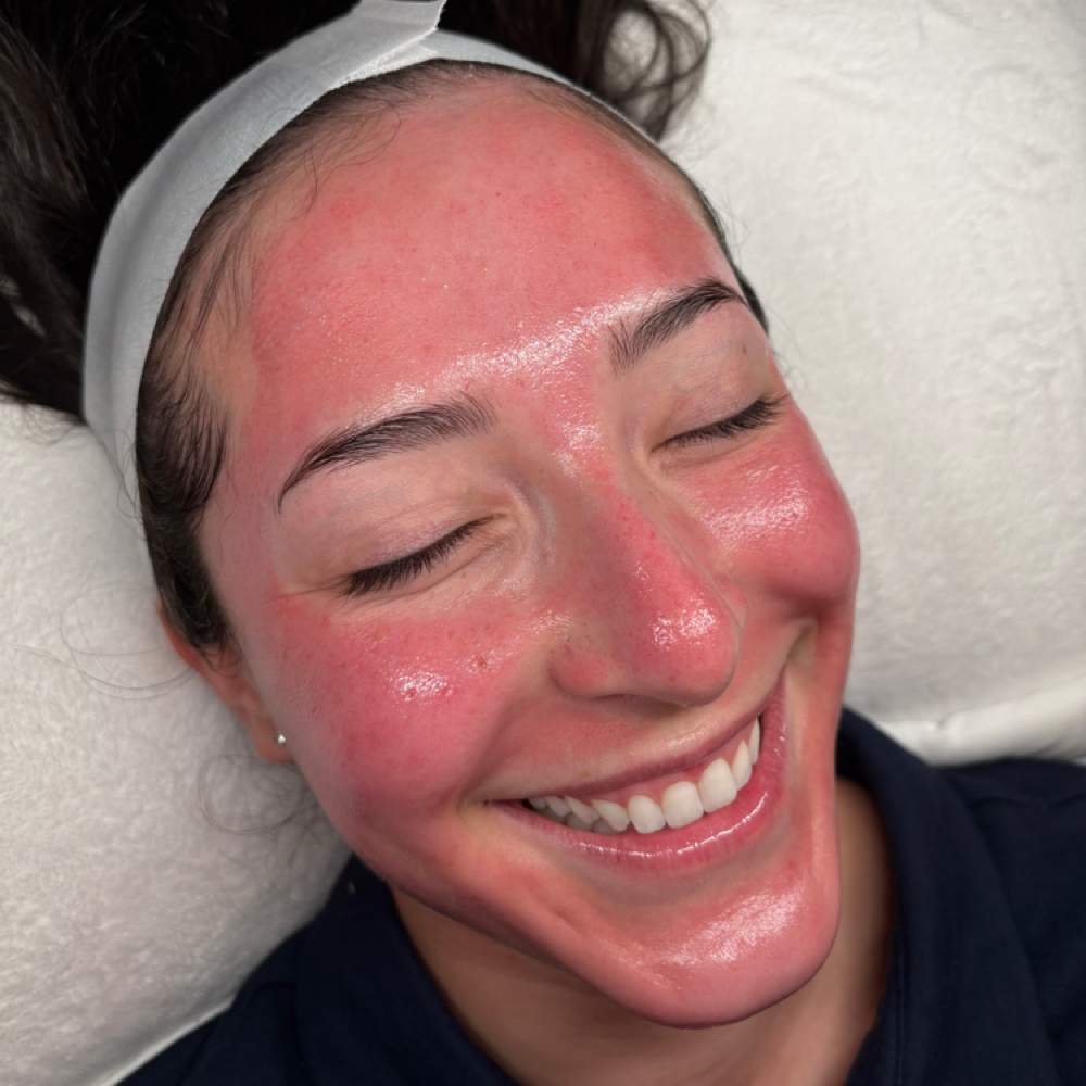 Microneedling at Euphoria Skin in Chandler, AZ