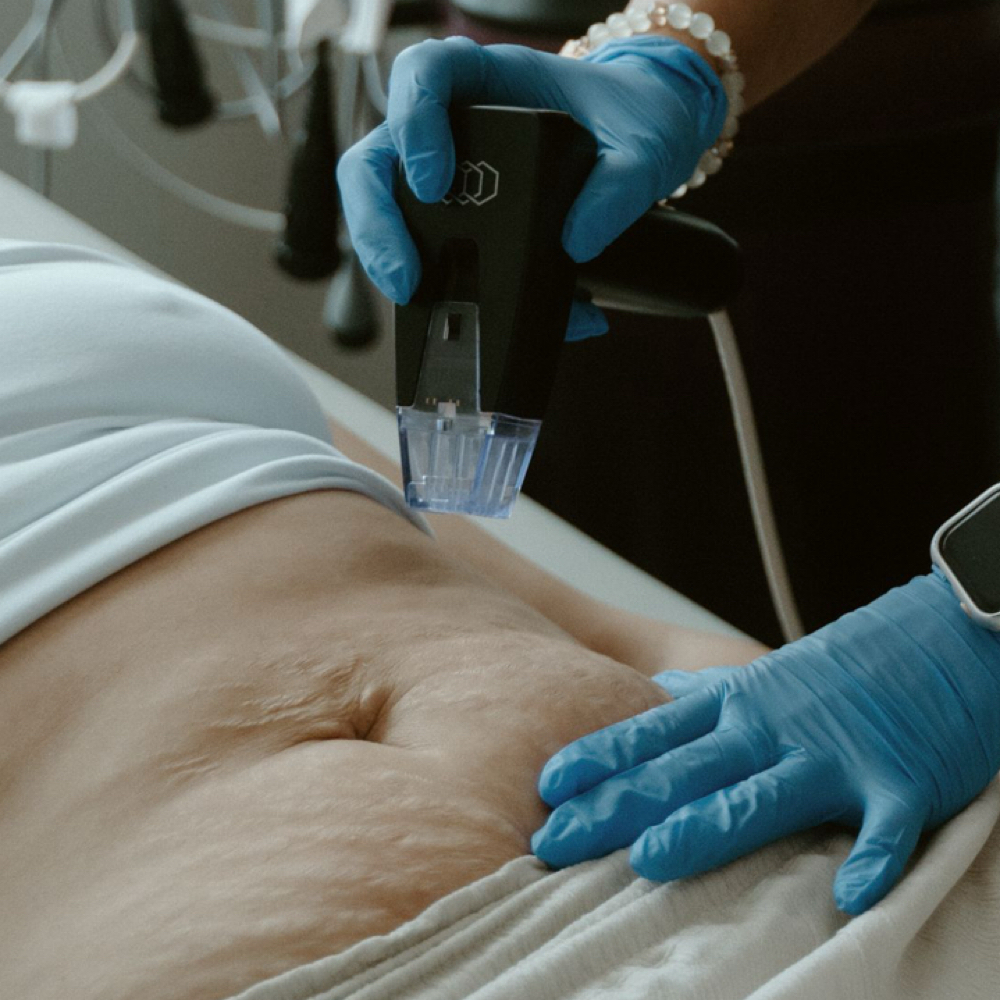 RF BODY at MB BEAUTY CLINIC | AESTHETICS | PMU in Nantucket, MA