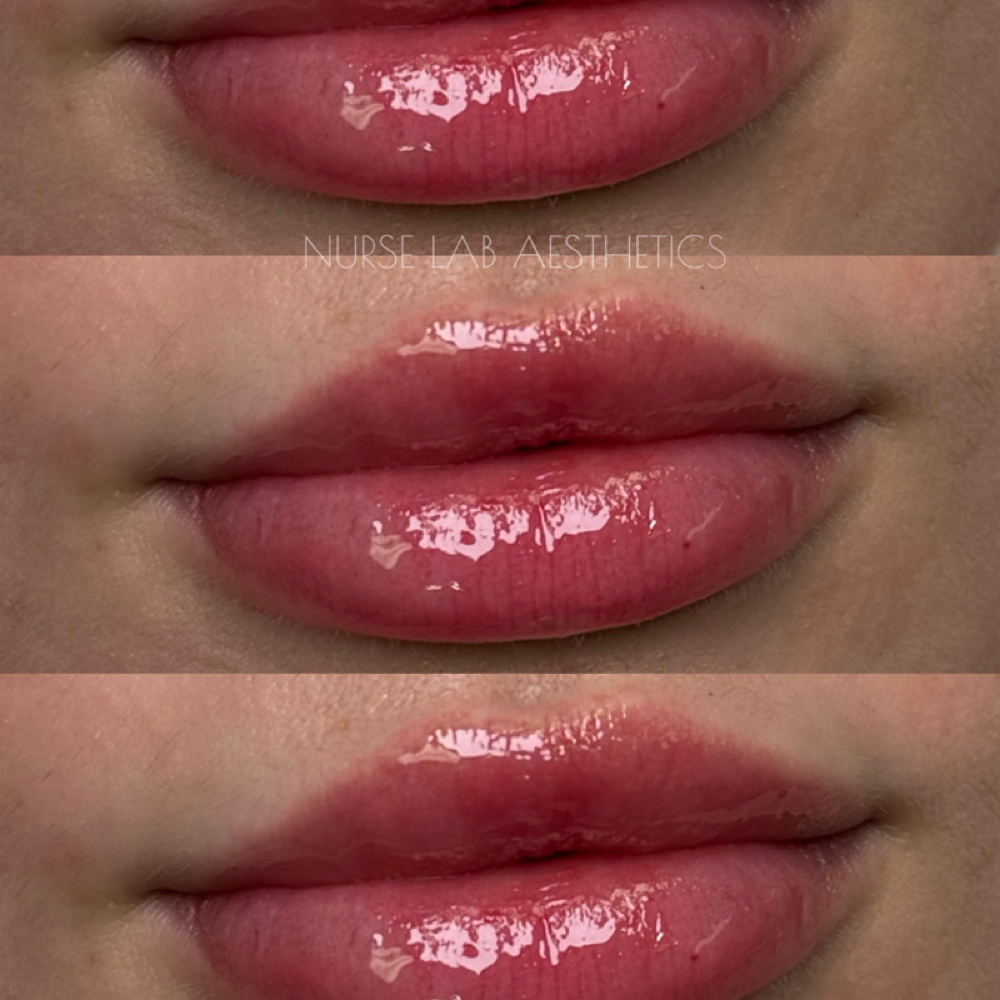 Lip Filler at Nurse Lab Aesthetics & Wellness in Mission, TX