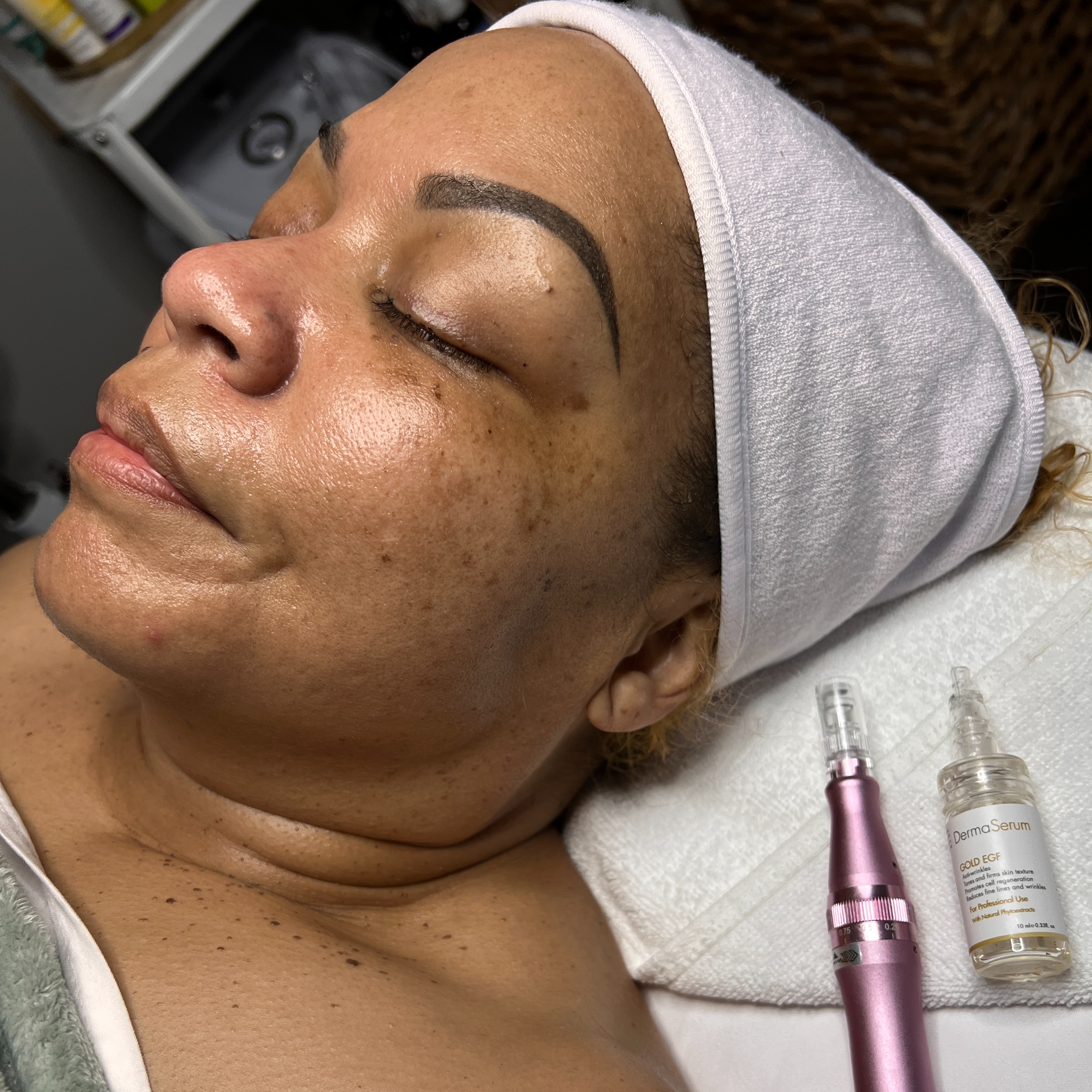 Microneedling at Serenity Aesthetics by Denise in St. John’s, FL