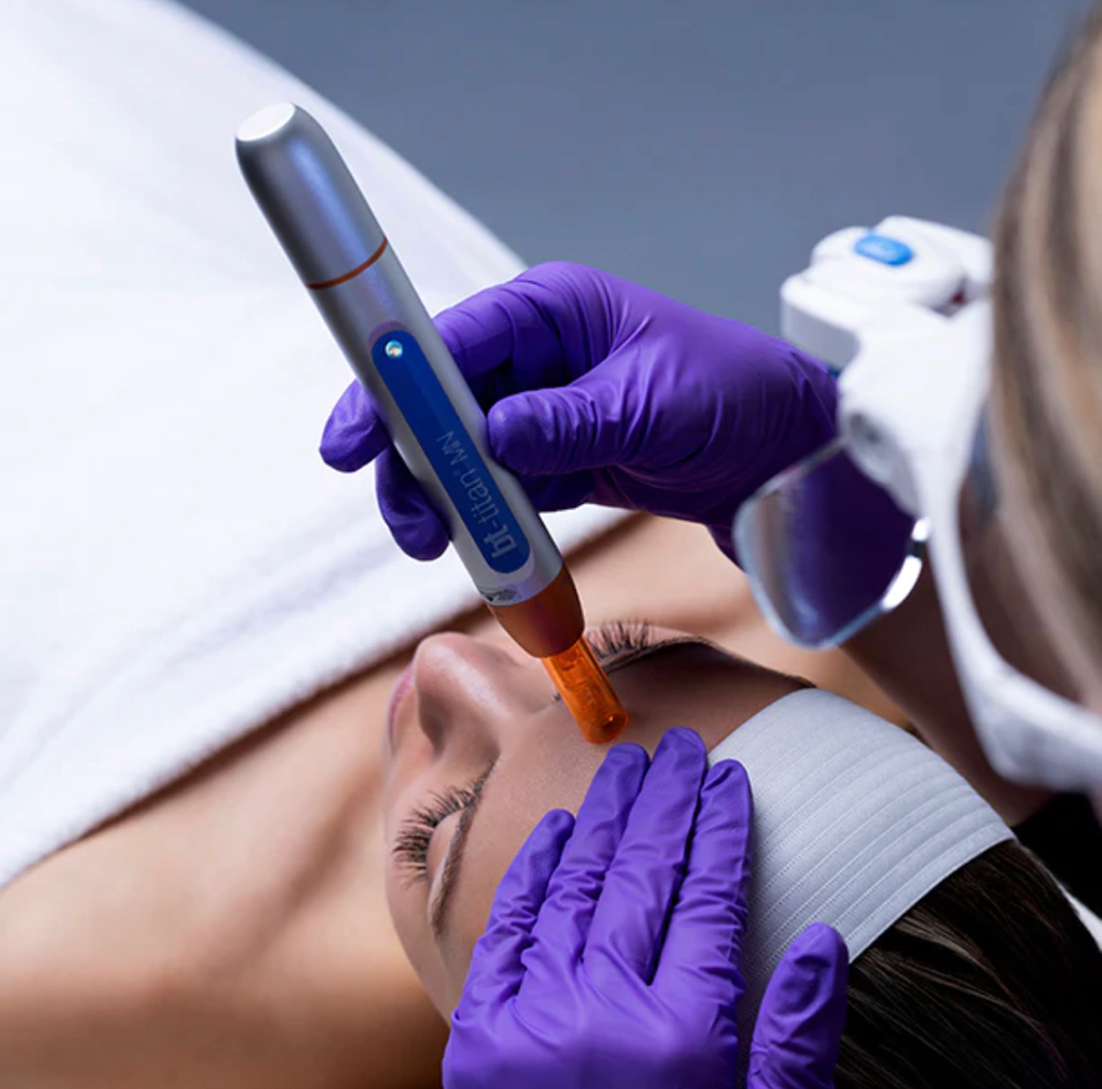 Nanoneedling Treatment