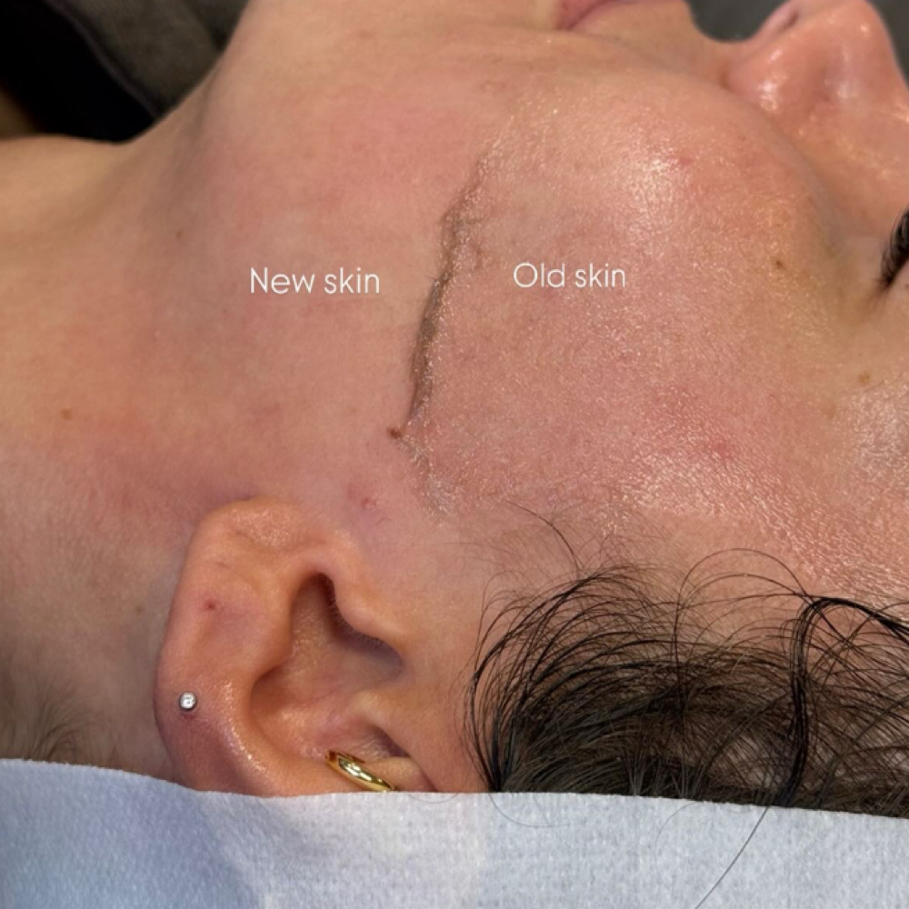 Dermaplaning Facial at Mo Esthetics LLC in South Salt Lake, UT