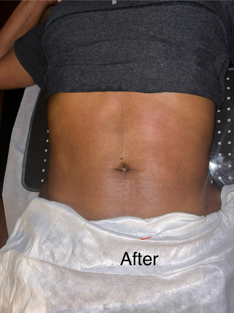 Non invasive lipo Suction Treatment