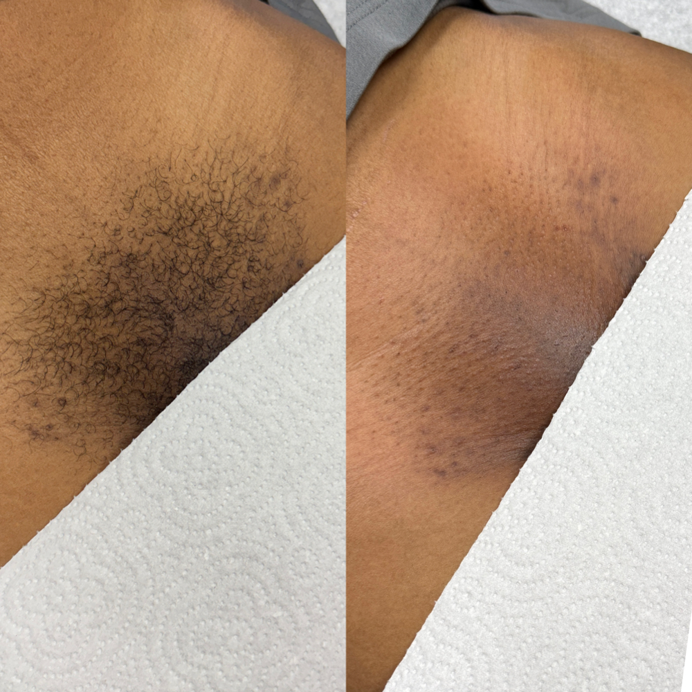 Brazilian Wax (New Client) at The SKN Studio in Greenville, NC