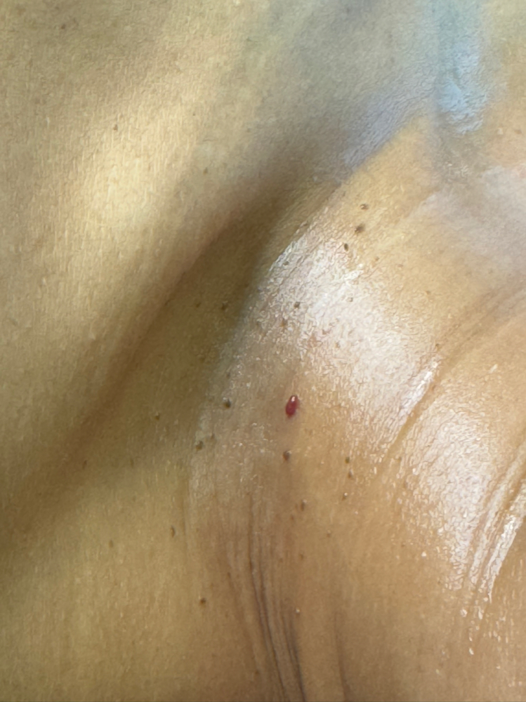 Skin Tag Removal 10$/pc