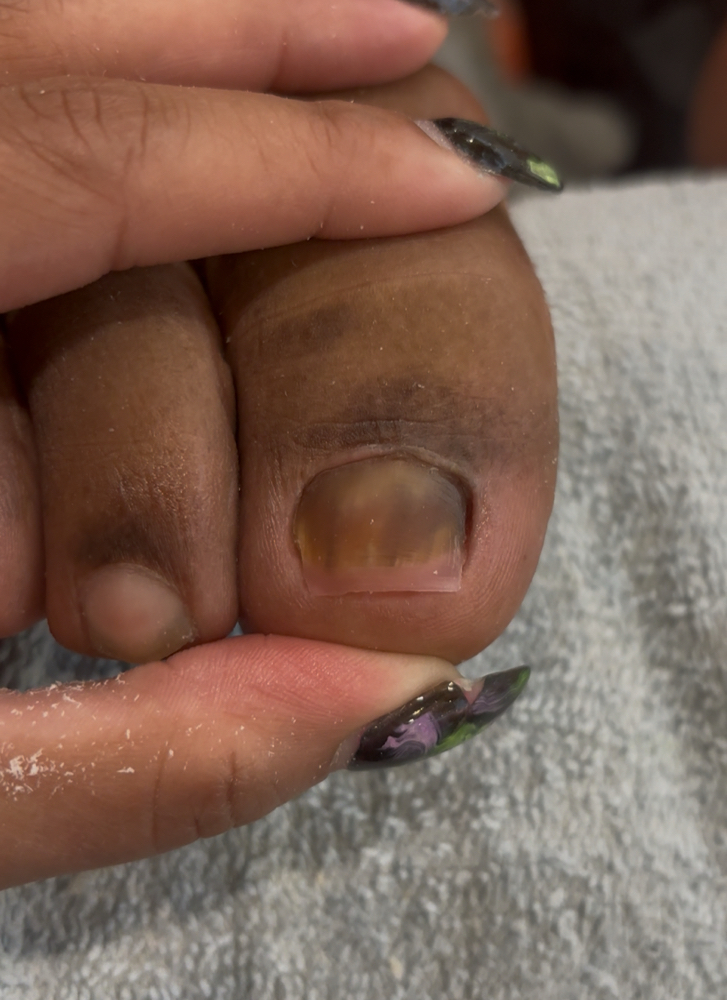 Toenail Restoration