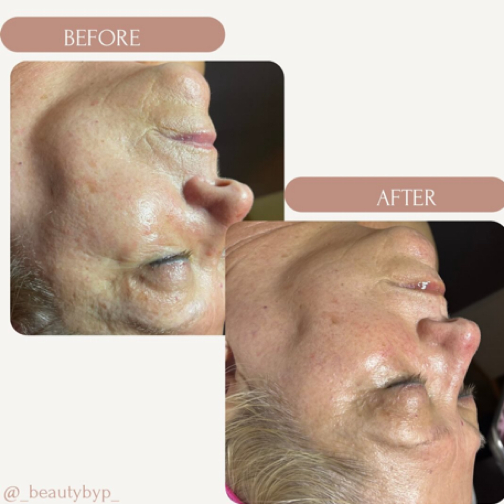 Anti-Aging”Botox”Facial at Peyton Bustamante in Harrisburg, IL