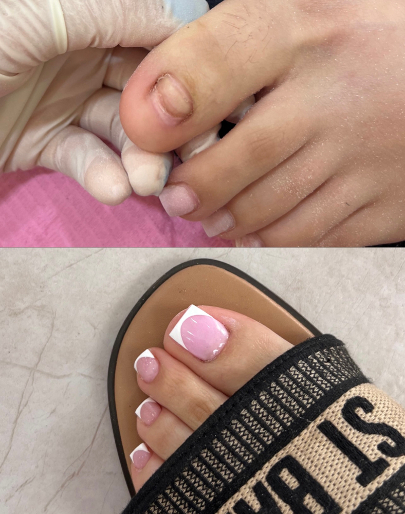 Toe Recontruction