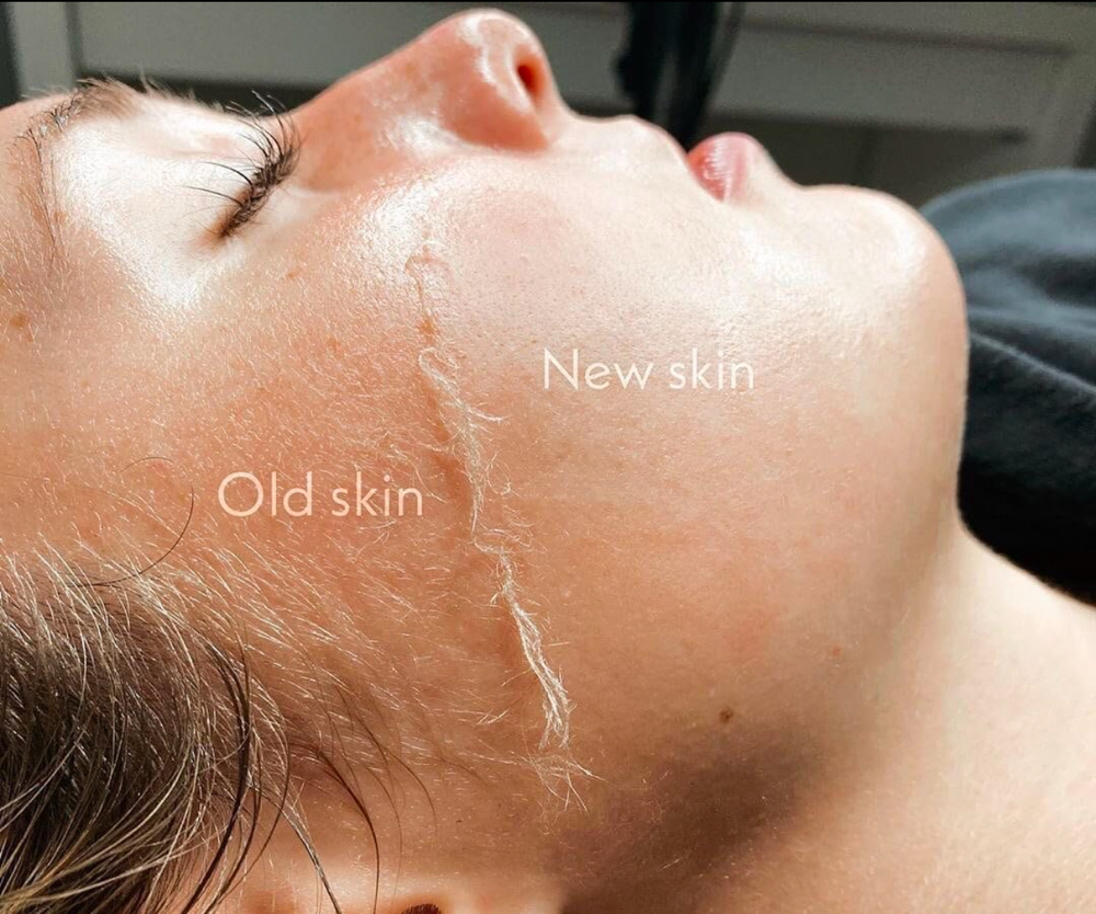 Dermaplane
